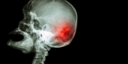 Stroke visual